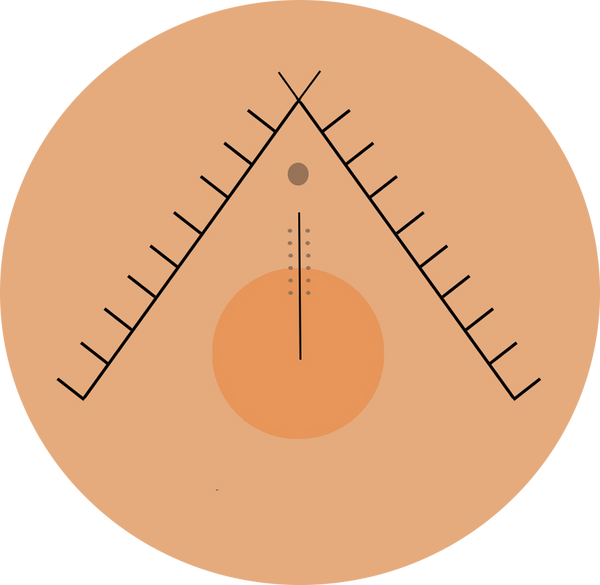 Surcoma